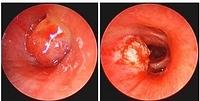 Diathermy resection of an endobronchial carcinoid