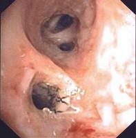 Endobronchial stent placement