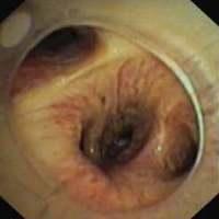 Pattency of the right middle and lower lobe bronchi after placement of an OKI stent