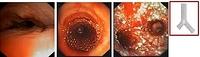 Y shaped tracheobronchial stent