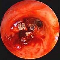 Tumour debulking with laser photocoagulation