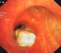 Endobronchial lymphoma obstructing the truncus intermedius (before debulking)