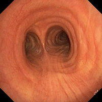 Normal lower respiratory tract