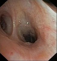 Left Lower Lobe Bronchus