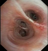 Left Basal Segmental Bronchi