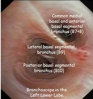 Left basal segmental bronchi - annotations