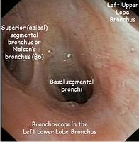 Left lower lobe bronchus - annotations