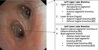 Left mainstem bronchus - annotations