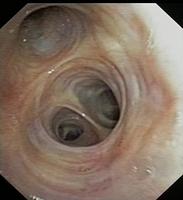 Left Upper Lobe Bronchus