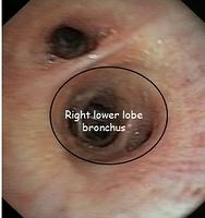 Right lower lobe bronchus