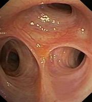 Right Upper Lobe Bronchus