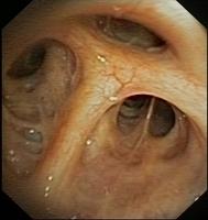 Right upper lobe bronchus