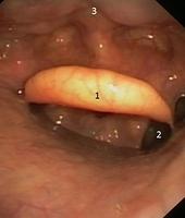 Normal upper respiratory tract