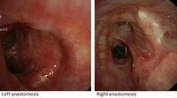 Lobar bilateral transplantation