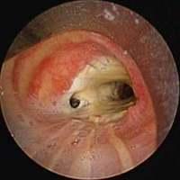 Dehiscence of the right anastomosis - Stented
