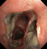 Necrosis of the left anastomosis