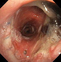 Necrosis of the right anastomosis