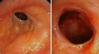 Anastomotic stenosis before and after balloon dilatation