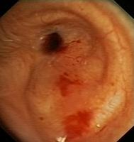 Circumferential anastomotic stenosis of the left mainstem bronchus