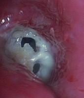 Diaphragm-like stenosis associated with fibrin deposition