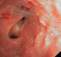 Anastomotic stenosis of the distal left mainstem bronchus