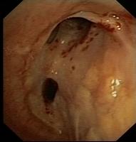 Anastomotic stenosis of the truncus intermedius