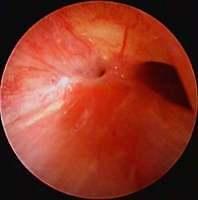 Stenosis of the truncus intermedius