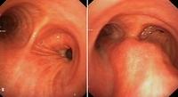 Excessive dynamic airway collapse (trachea, mainstem bronchi) and bronchomalacia (right anastomosis)