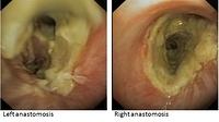 Case 1: bronchoscopic follow-up