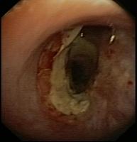 Left anastomosis: 3 months after transplantation