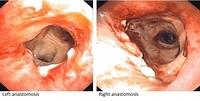 Anastomoses and endobronchial anatomy in uncomplicated cases