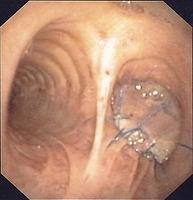 Bronchoplasty (muscle flap): right pneumonectomy