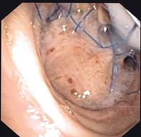 Dehiscence post bronchoplasty