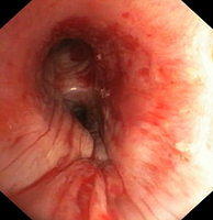 Bronchoplasty (muscle flap): right mainstem bronchus