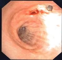 Bronchial stump dehiscence