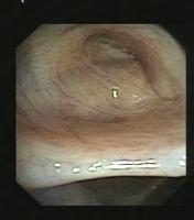 Normal Bronchial Stumps