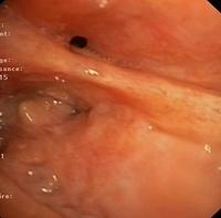 Bronchial stump of the RLL