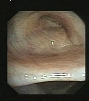 Bronchial Stump of the Middle lobe