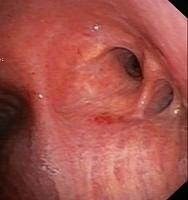 Normal anastomosis after sleeve resection