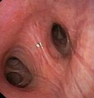Sleeve resection of the Middle lobe and the RUL