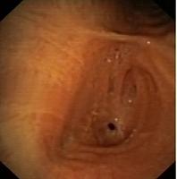 Anastomotic stenosis after sleeve resection