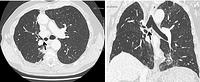 Stenosis of the right mainstem bronchus after sleeve resection