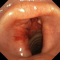 Tracheostomy