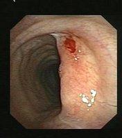 Tracheal stenosis after prolonged endotracheal intubation and tracheostomy