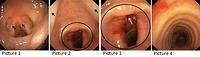 Tracheal stenosis after tracheostomy (stages of bronchoscopy, annotations)