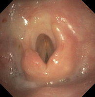 Upper respiratory system