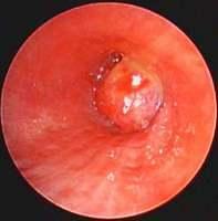 Lung neuroendocrine tumors (Carcinoids, SCLC, LCNEC)