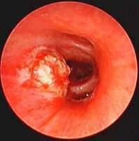 Carcinoid after diathermy resection
