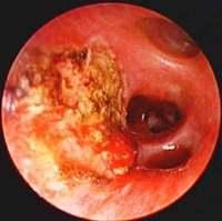 Carcinoid after laser coagulation