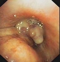 Large cell neuroendocrine carcinoma (LCNEC)